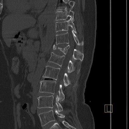 compression test fracture|compression fracture without retropulsion.